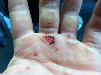 Next time I will also be practicing better hand care...About 1 minute in bye, bye skin on both hands.